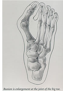 bunion