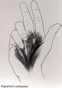 dupuytren
