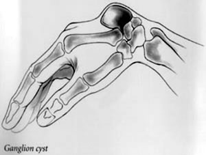 ganglion