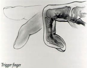 trigger